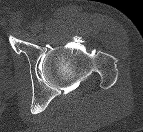 X-ray: FAI due to CAME effect
