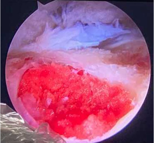 ArthroCT: very mild osteoarthritis. Alpha angle > 70°, no labral lesion