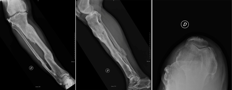 Management-of-Total-Knee-Arthroplasty-in-Post-Traumatic-Malunion-figure1