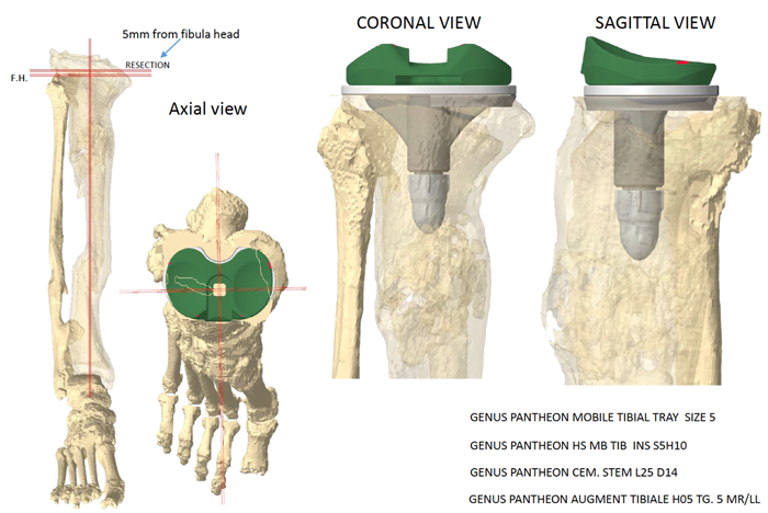 Management-of-Total-Knee-Arthroplasty-in-Post-Traumatic-Malunion-figure3