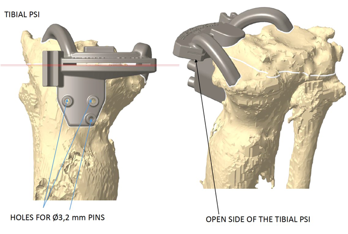 Management-of-Total-Knee-Arthroplasty-in-Post-Traumatic-Malunion-figure4