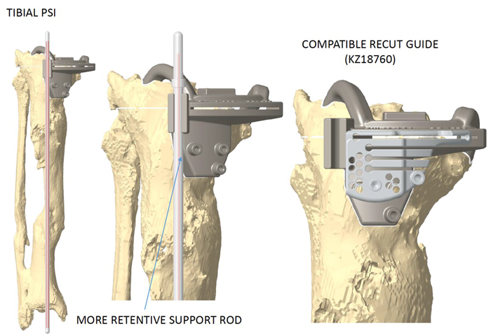 Management-of-Total-Knee-Arthroplasty-in-Post-Traumatic-Malunion-figure5