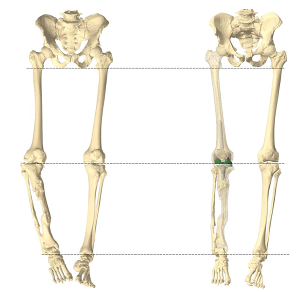 Management-of-Total-Knee-Arthroplasty-in-Post-Traumatic-Malunion-figure6