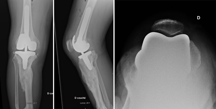 Management-of-Total-Knee-Arthroplasty-in-Post-Traumatic-Malunion-figure7