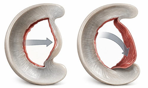 Bucket-handle tear: a clinical point of view