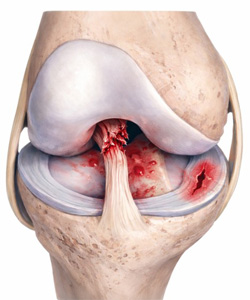 Bucket-handle tear + ACL tear