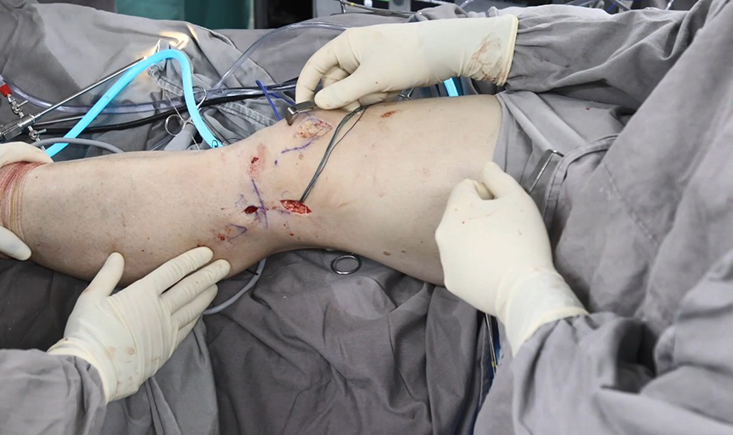 Virtual fellowship: All you need to know on new grafts for ACL with Camilo Helito