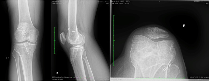Normal leg alignment 