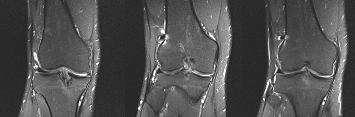 Pre-op MRI