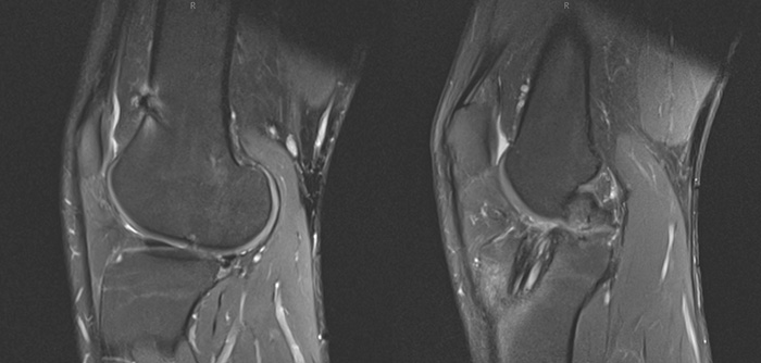 Knee subluxation  Normal tibial slope