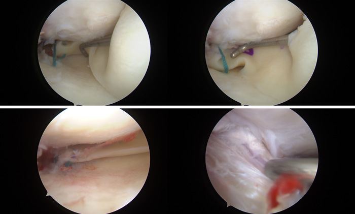 Medial meniscus transplantation