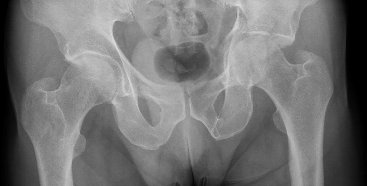 coxarthrosis secondary to a complex acetabular fracture : Pre operative X-Rays