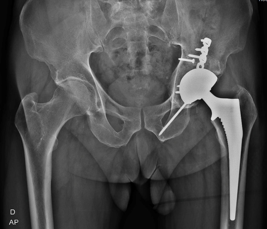 coxarthrosis secondary to a complex acetabular fracture : final X-ray