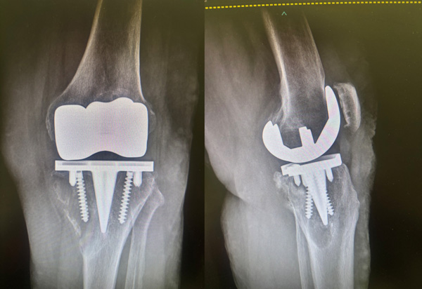 Xray