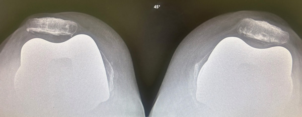 Xray