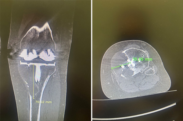 Extensive medial metaphyseal epiphyseal periprosthetic osteolysis with thinning of the cortex