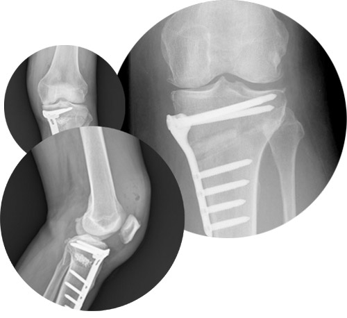 High tibial osteotomy