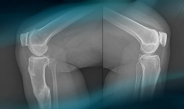 Post-traumatic knee pain: How to treat double varus deformity?