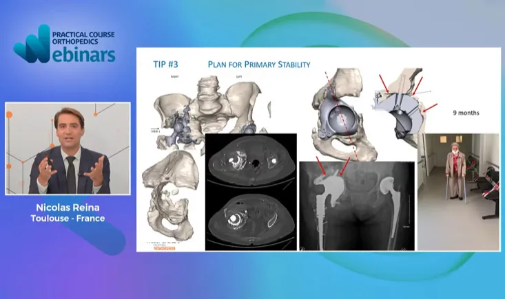 How new technologies could help solving complex reconstruction cases with major bone loss