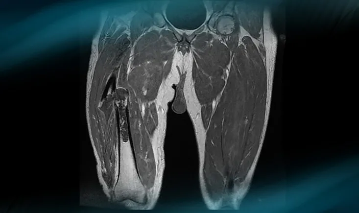 Dedifferentiated chondrosarcoma