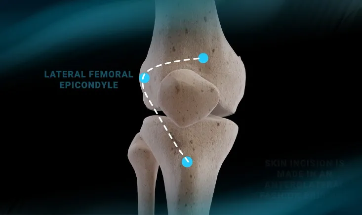 Chistera approach to total knee arthroplasty
