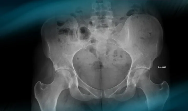 Management of hip pain in a 30-year-old woman