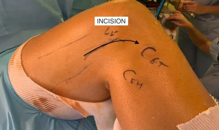 Outside-in anterior cruciate ligament revision is easy to perform witht the iliotibial band