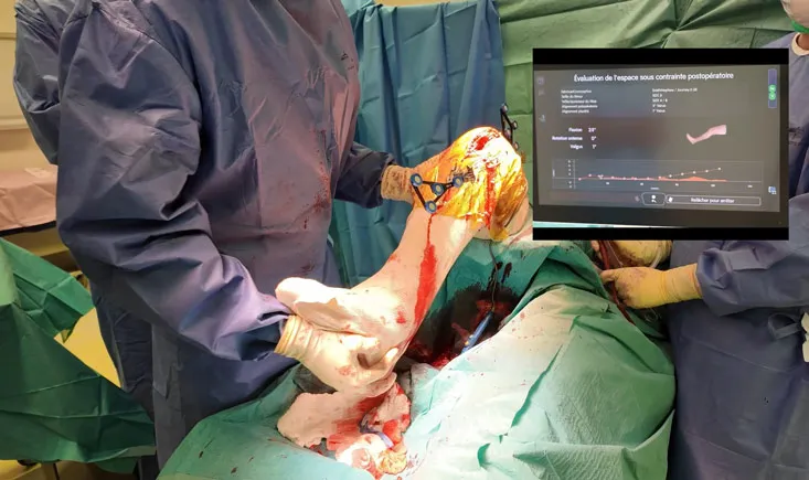 Functional UKA with CORI Surgical System