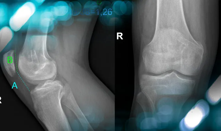 Management of a postoperative persistent patellofemoral instability in a young athlete