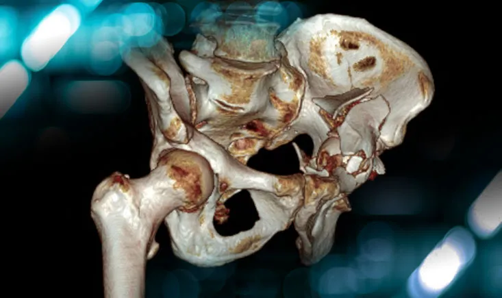 Management of a sequela of an acetabular fracture