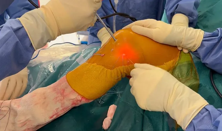 Combined anatomical arthroscopic posterior cruciate ligament and posterolateral corner reconstruction using a knotless anchor: a simplified approach