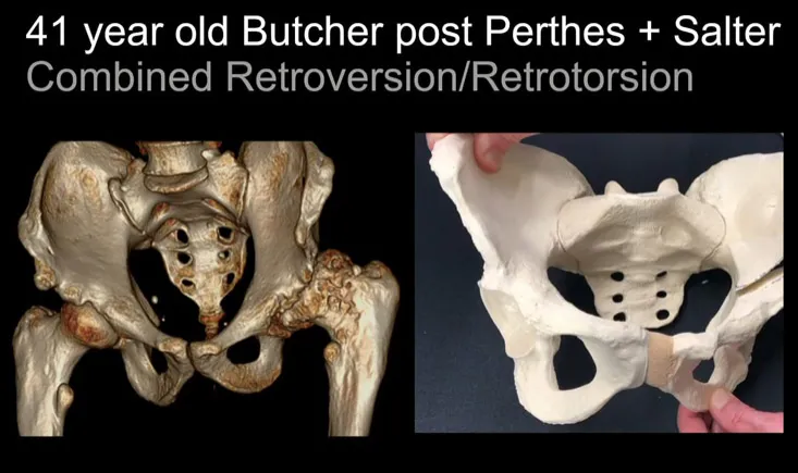 Arthroplasty in the Young Adult 