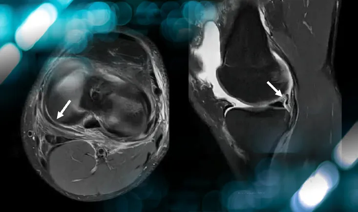 Ramp Lesion