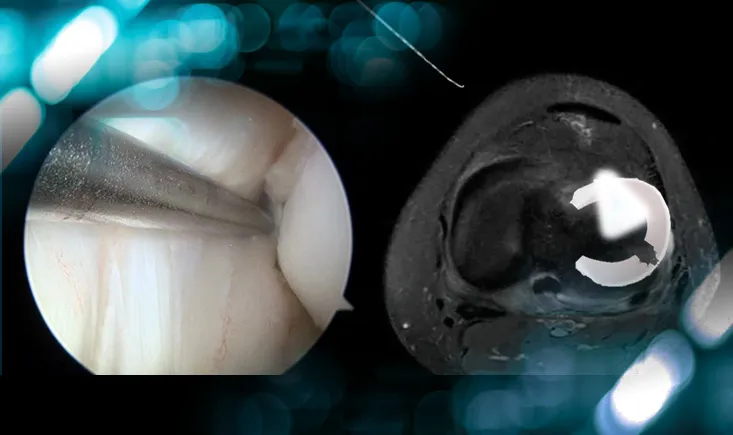 Radial tear