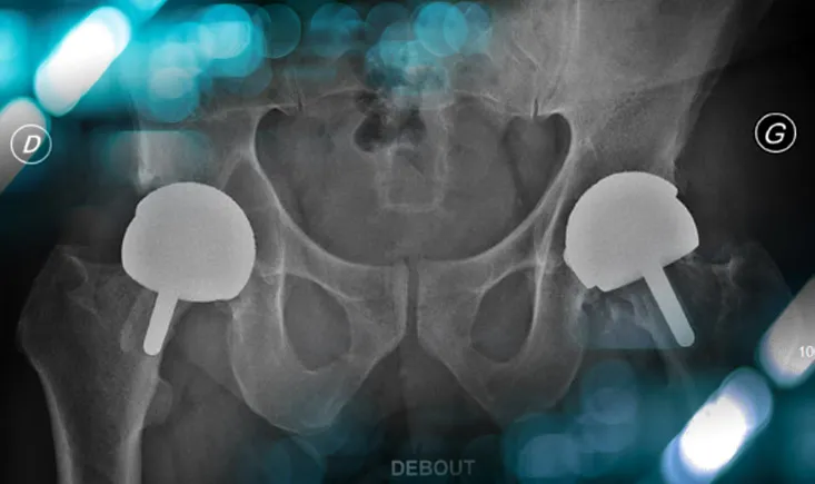 Management of a severe bone loss in a patient with hip resurfacing