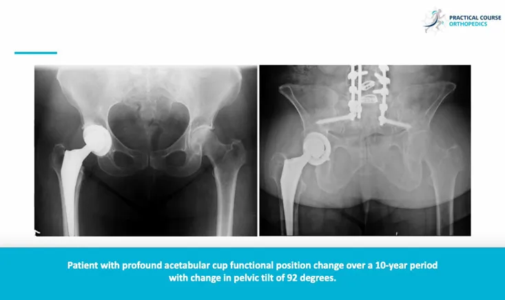 Excellence in hip research award: Pelvic tilt and cup position change significantly in most young patients 10 years after hip arthroplasty