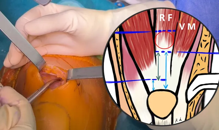Harvesting Rectus Femoris for ACL reconstruction: a step by step approach