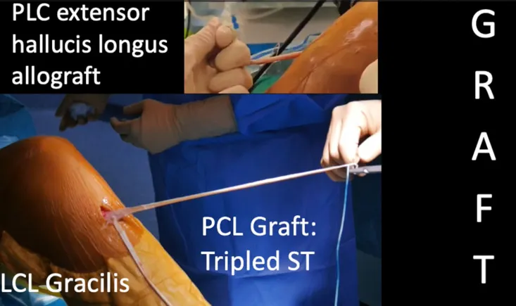 Minimally invasive approach to multi-ligament knee reconstruction: arthroscopic PCL and PLC with percutaneous LCL reconstruction