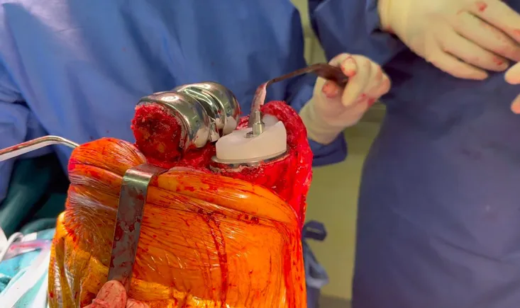Revision Total Knee Arthroplasty using the EnduRo® Hinged prosthesis (B.Braun): surgical technique
