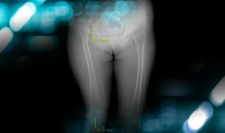 Management of a hip dysplasia in a middle-aged woman