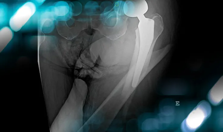 Management of a peri prostetic femoral fracture