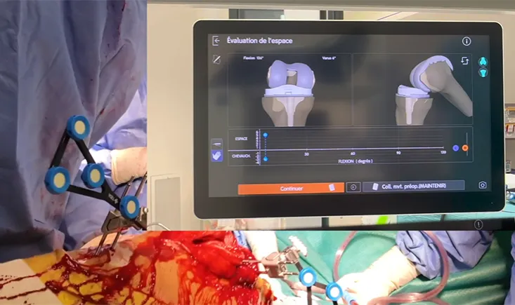 Revision of unicompartmental knee arthroplasty to total knee arthroplasty using a robotic system : a smart, efficient and conservative approach