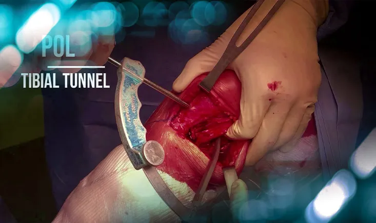 Combined anterior cruciate ligament reconstruction (ACLR) revision and double-bundle medial collateral ligament (MCL) and posterior oblique ligament (POL) reconstruction