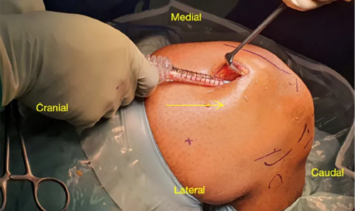 ACL Reconstruction Rectus Femoris Quad 2.0