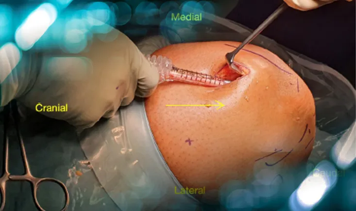 ACL Reconstruction Rectus Femoris Quad 2.0