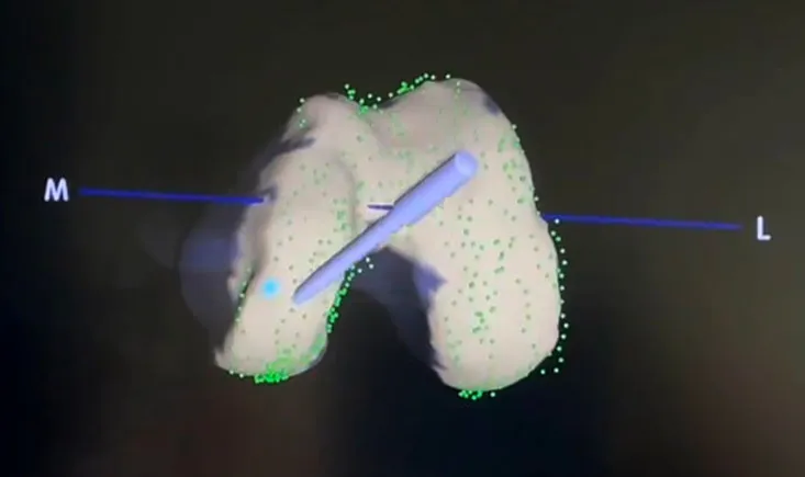 Robotic UKA-to-TKA revision : Personalized intraoperative balancing without routine use of stems or augments