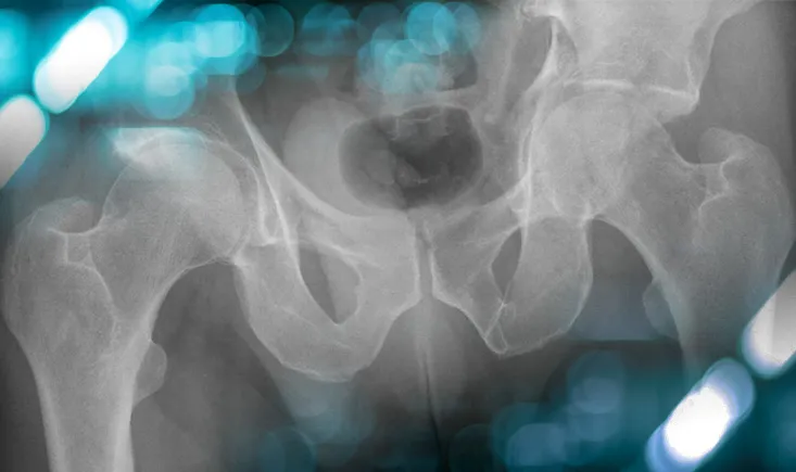 Management of a coxarthrosis secondary to a complex acetabular fracture