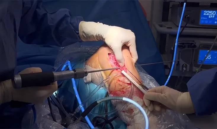 Rectus Femoris Tendon : A single continuous autograft for combined Anamatomic reconstruction of SMCL, dMCL and pol-a technical note