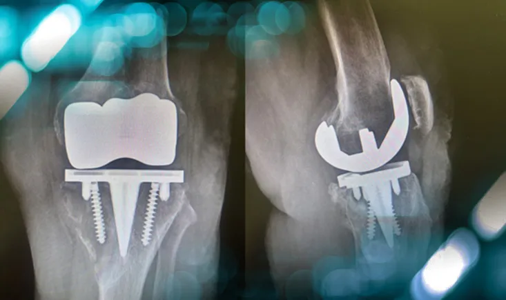 Clinical Challenge: How would you address this complex revision TKA case?