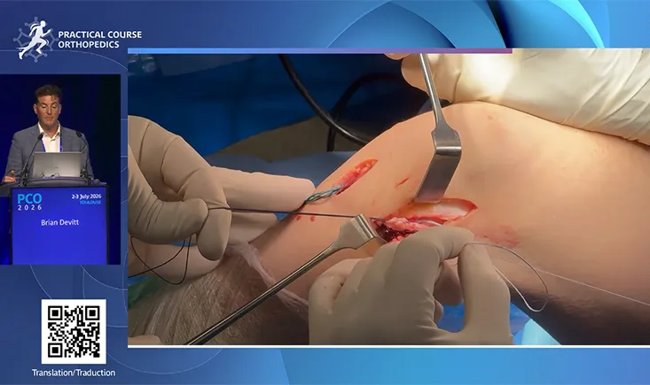 ACL reconstruction with lateral extra-articular tenodesis (LET): understanding the modified Ellison procedure